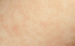 治疗寒冷性荨麻疹的偏方 