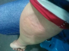 过敏性荨麻疹的症状