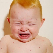 导致儿童荨麻疹的原因 