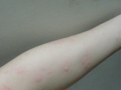 秋季荨麻疹有哪些症状 