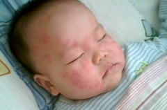 改善小儿荨麻疹的护理事项 