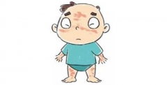 急性荨麻疹应该怎么治