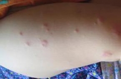 治愈慢性荨麻疹困难吗