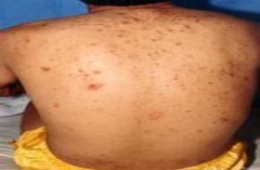 丘疹性荨麻疹发作时有哪些症状 