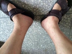 接触性皮炎症状你都知道吗