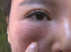面部反复过敏痒怎么办