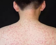 什么是季节性皮炎