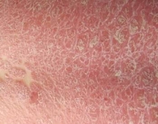 牛皮癣的治疗方案