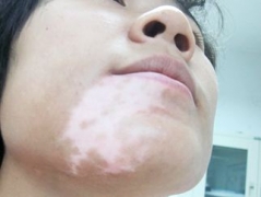 白癜风的危害需清楚