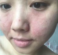 季节性皮炎的症状与治疗