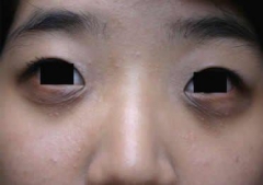 异位性皮炎症状与原因