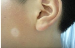 白癜风患者如何预防分散