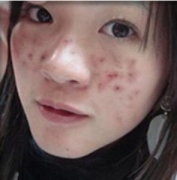 脸上痤疮怎么治