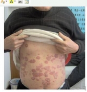 牛皮癣的发病表现