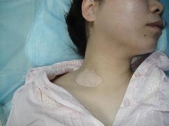 白癜风疾病久治不愈怎么办