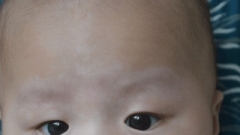 儿童白癜风怎样进行护理