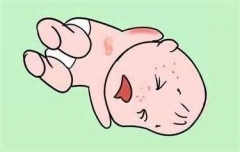 异位性皮炎病因及其防治