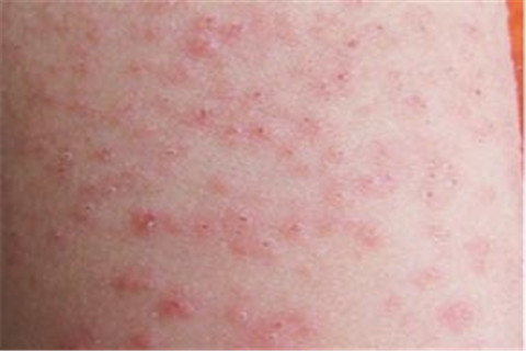 夏季荨麻疹为何反复发作 