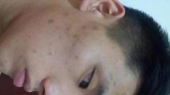 怎样科学化的区分痤疮与其它皮肤病