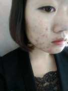 痤疮患者饮食注意事项当科学化了解