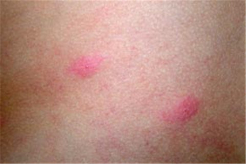 过敏性荨麻疹诱发因素有哪些 
