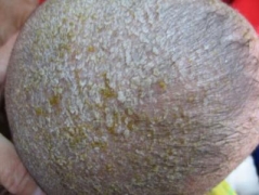 青岛市南皮肤专家论述头部脂溢性皮炎主要症状及怎样科学化医治 