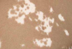 科学认知白癜风的秋季主要症状特点以尽早发现并医治