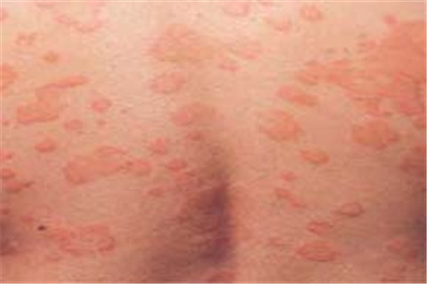 导致过敏荨麻疹的原因有哪些