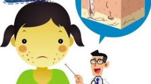 潍坊如何预防激素过敏性皮炎