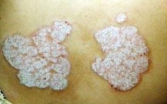 知悉牛皮癣预防事项 展开针对性有效医治