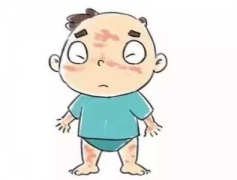科学化了解致使季节性皮炎形成的因素