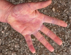 科学化了解致使手部湿疹形成的因素 