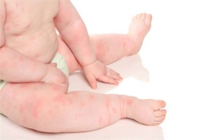 烟台宝宝对奶粉过敏的症状 