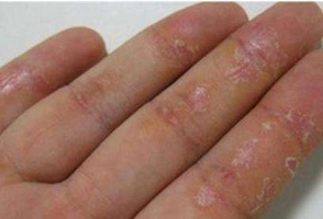 城阳皮肤病专家讲解慢性皮炎的病因 