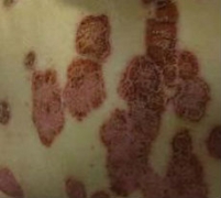 牛皮癣疾患产生的损害要全面认知