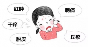 临沂季节性皮炎的预防与治疗