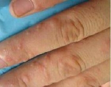 手部湿疹防备的护理要点需科学认知 