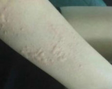 过敏性荨麻疹防治的护理办法 