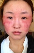 激素依赖性皮炎形成的致病性原因当科学认知