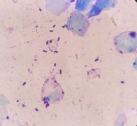 致使异位性皮炎产生的原因要科学认识