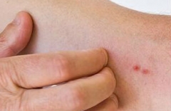 防治冬季皮肤瘙痒形成的护理方法需全面了解 