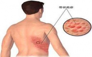 临沂患上带状疱疹会带来的危害 