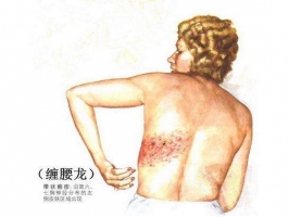 潍坊秋季怎么预防带状疱疹的发生