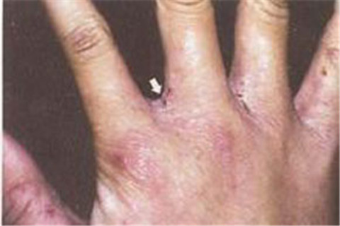 手部湿疹有哪些症状表现 