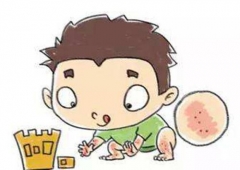 小儿荨麻疹治疗的药用方法需科学掌控
