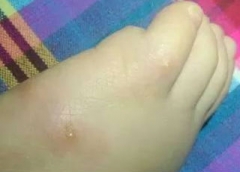 祛除丘疹型荨麻疹的医治办法当科学运用