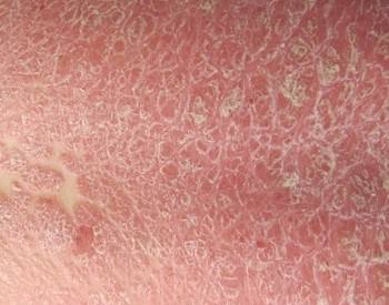 秋季牛皮癣该怎么治疗与护理
