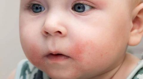 青岛的宝宝奶粉过敏会出现什么症状 