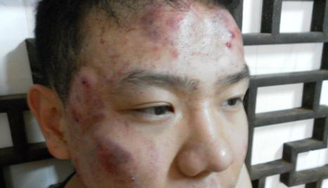 科学化的了解职业性痤疮是什么