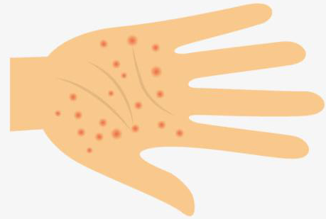 清晰认识手部湿疹改善的护理要点 